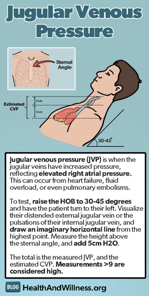 Jugular Vein Distention