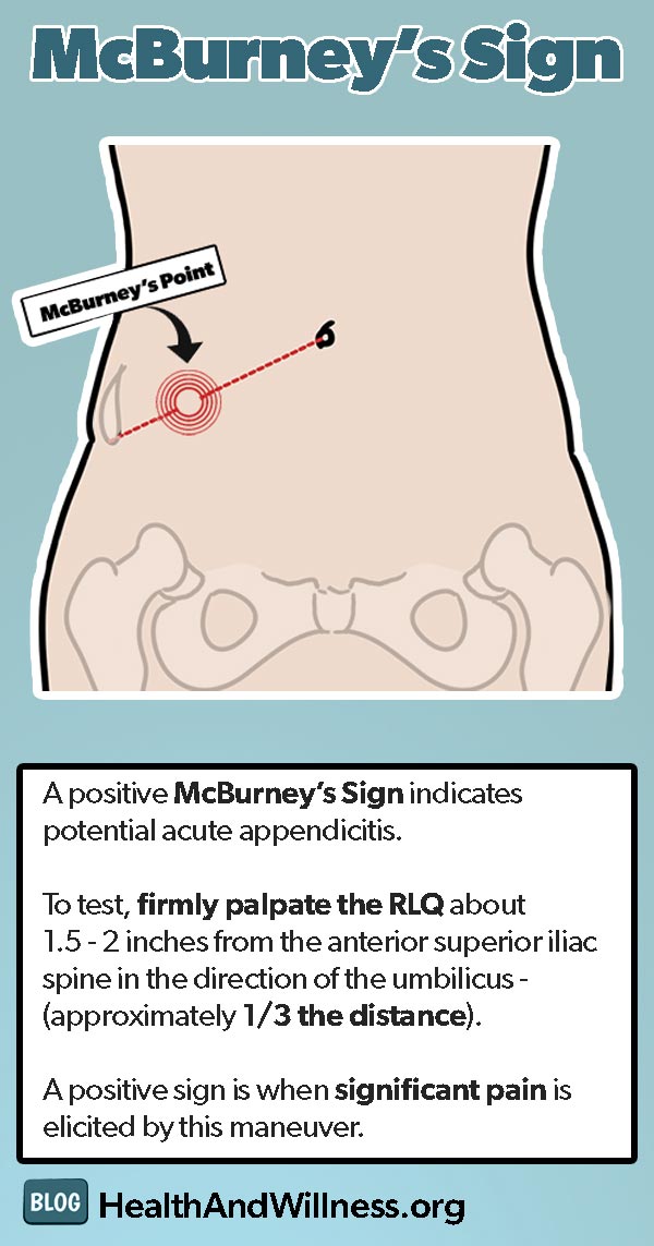 McBurney's Sign for acute appendicitis