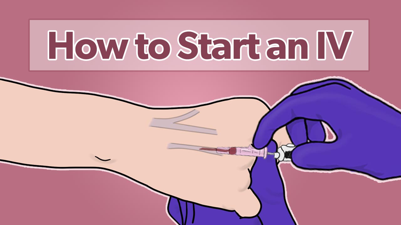 How to start an IV: Feat