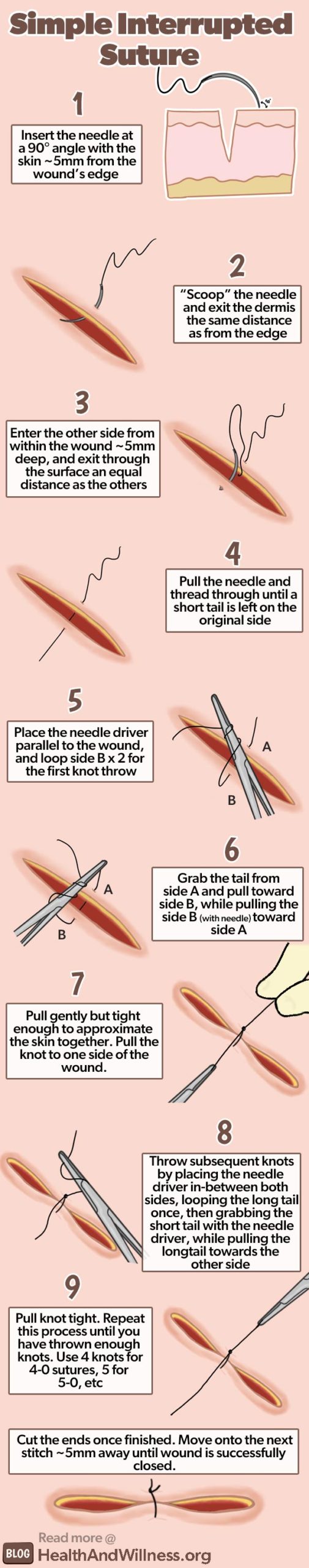 interrupted suture