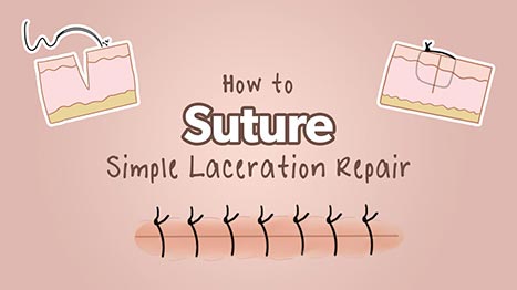 How to Identify and Repair a Laceration Like a Professional