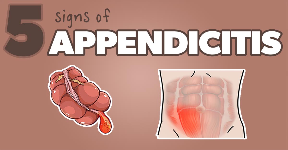 Appendicitis signs - FB