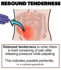 Appendicitis signs - Rebound