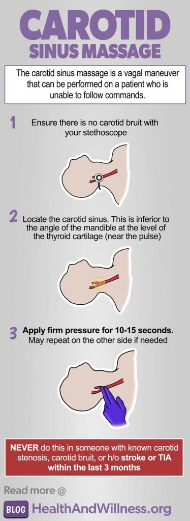 Carotid sinus massage infographic