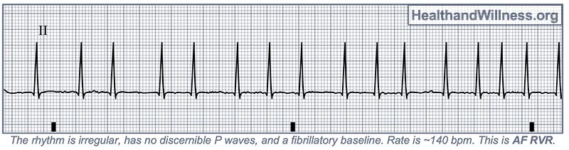 atrial fibrillation rhythm strip