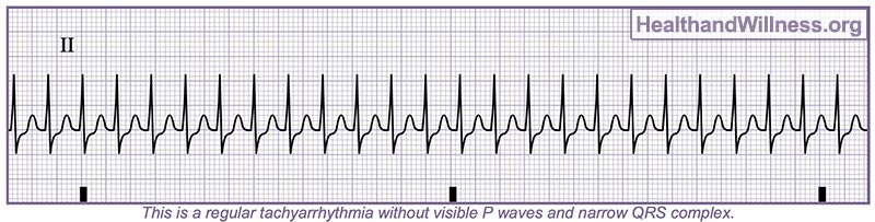 How to Read an EKG Rhythm Strip Health And Willness