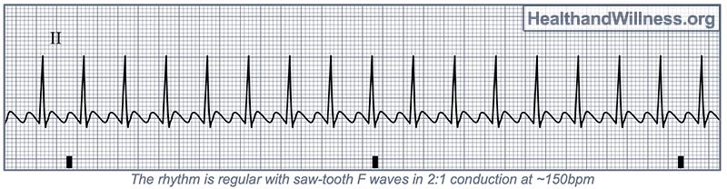 EKG Interpretation for Nurses