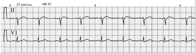 myocardial infarction ecg strip