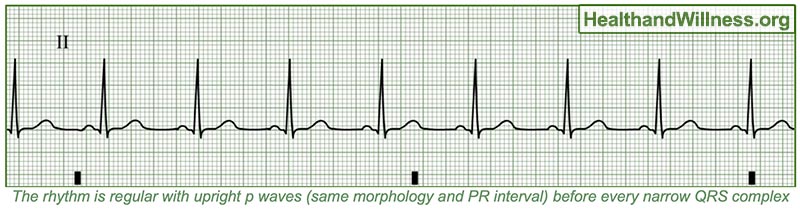 ekg pulseless electrical activity