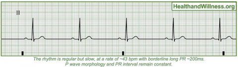 How to Read an EKG Rhythm Strip | Health And Willness