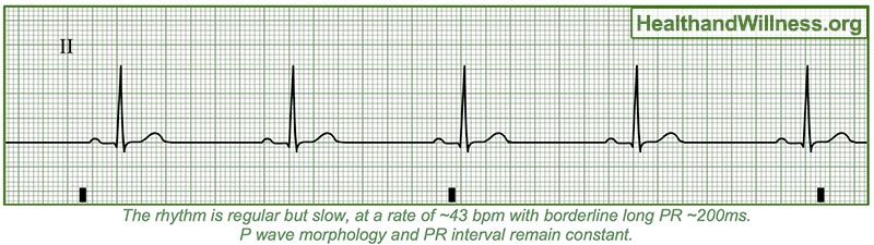 How To Read An Ekg Rhythm Strip Health And Willness