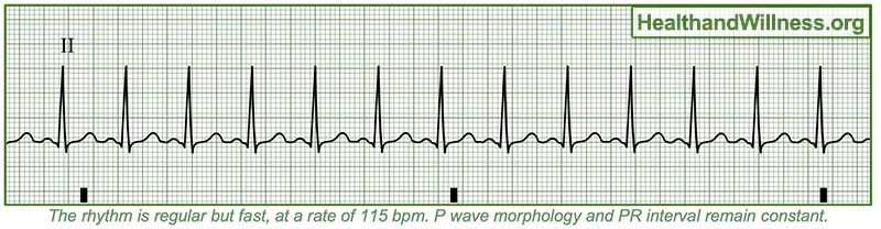 How to Read an EKG Rhythm Strip | Health And Willness