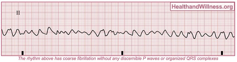 how-to-read-an-ekg-rhythm-strip-health-and-willness