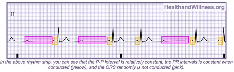 How to Read an EKG Rhythm Strip Health And Willness