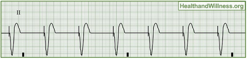 Pacemaker Rhythm Strips