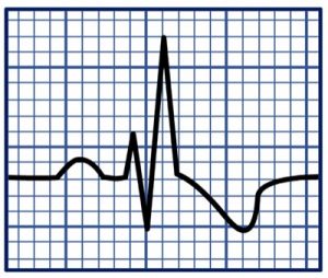 How to Read an EKG Rhythm Strip | Health And Willness