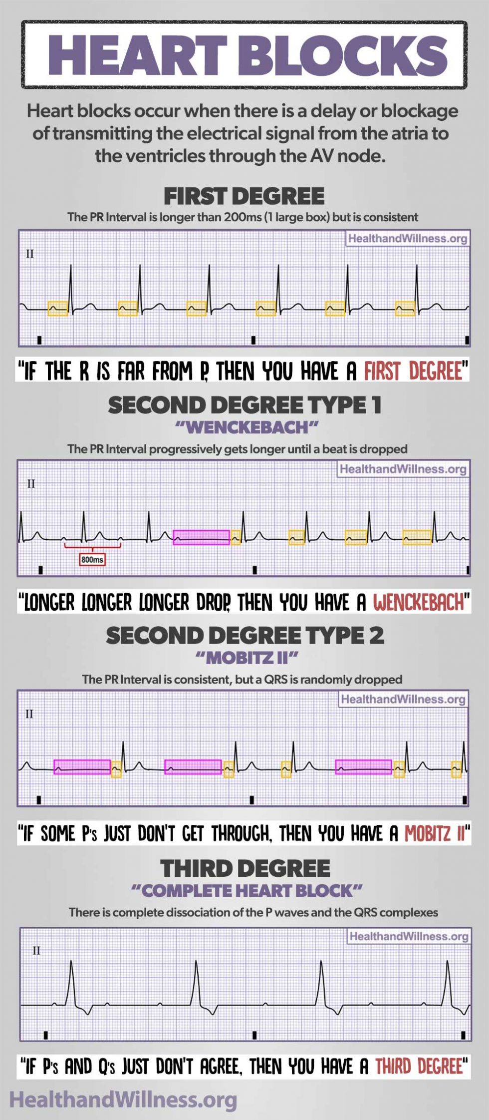 Ekg Rhythms Chart