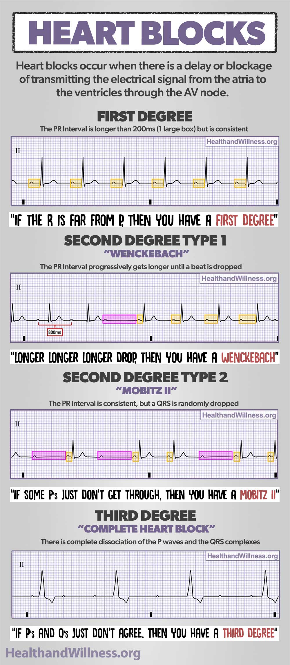 Heart Blocks EKG Rhythm Infographic