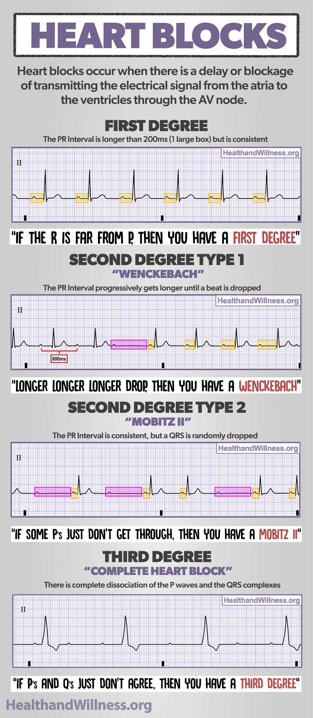 How To Read An EKG Rhythm Strip