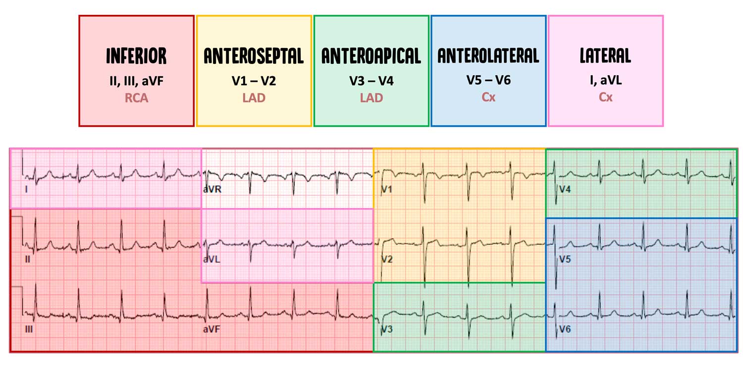 reciprocal changes ekg