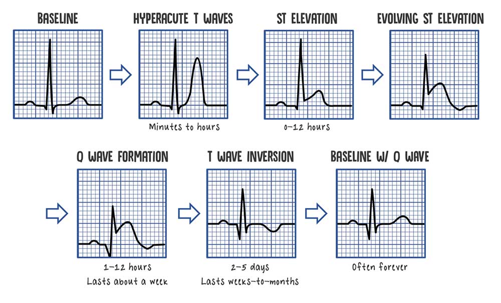 A: Follow-up electrocardiogram showing a 0.5 mm convex ST-segment