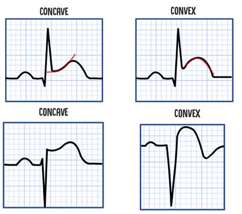 STEMI NSTEMI: A Nurse's Comprehensive Guide Health And