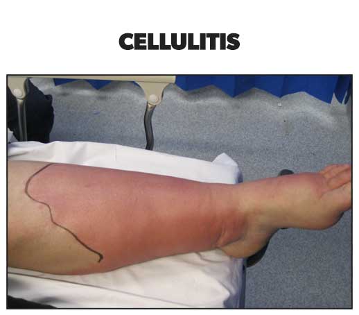 Skin rashes - cellulitis