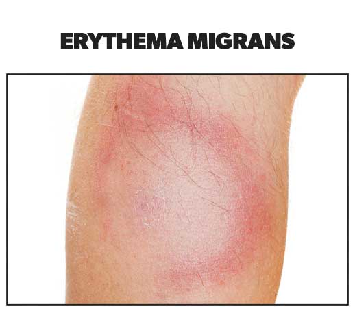 Skin rashes - erythema migrans
