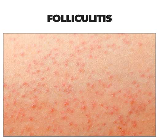 bacterial rash