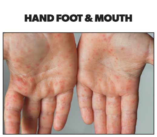 Rash on hand  MDedge Family Medicine