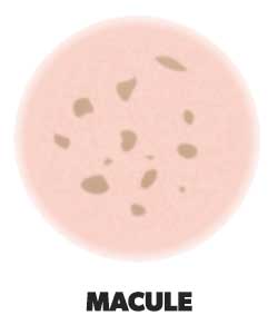 Skin rashes - macule