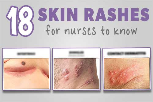 18 Acute Skin Rashes for Nurses to Know (with pictures)