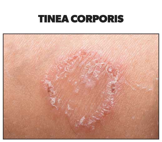 Skin rashes - tinea corporis