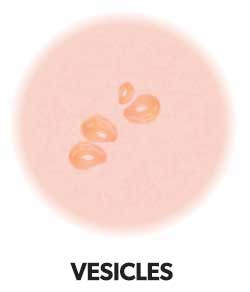 skin rashes - Vesicles