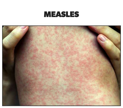 skin rashes - Measles