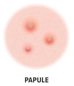 Skin rashes - papule