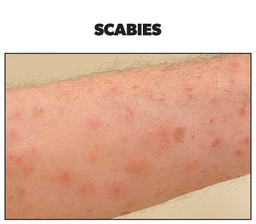 How to identify these three common rashes