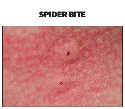 skin rashes - spider bite