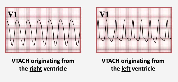 V Fib Contre V Tach