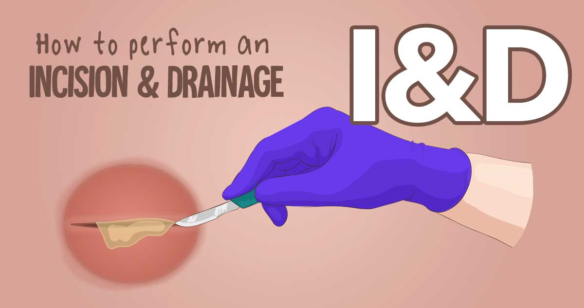 Learn how to do an I&D (Incision and drainage) including step-by-step instructions how to drain an abscess, antibiotic selection, whether or not to pack the abscess, and discharge instructions