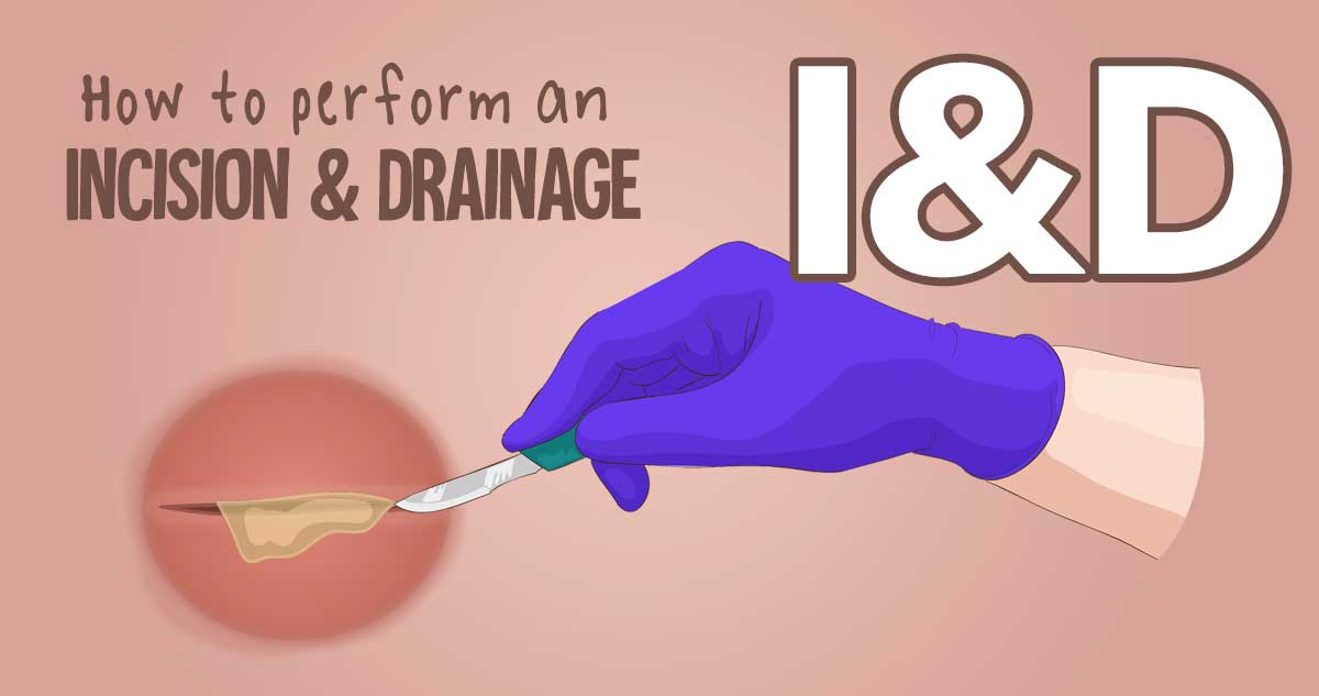 i-d-how-to-perform-an-incision-drainage-health-and-willness