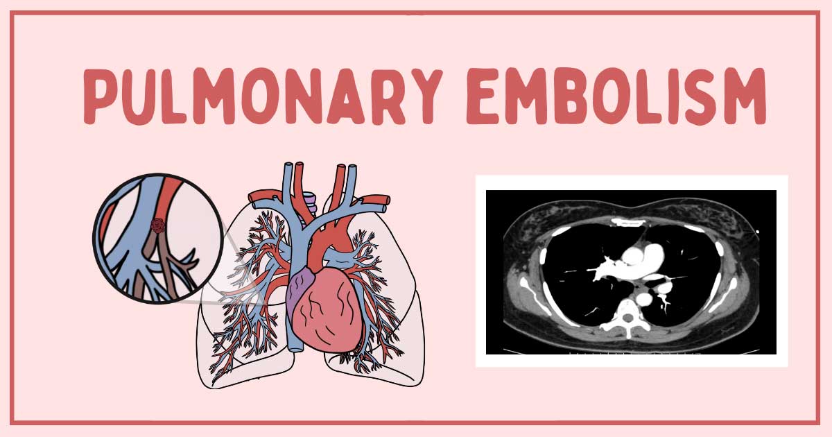 Pulmonary Embolism Nurses Reference Guide Health And Willness