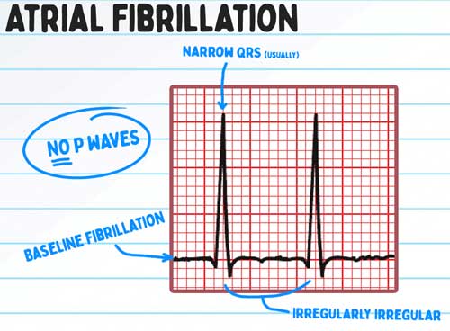 AFIB: Atrial Fibrillation Notes