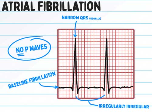 AFIB RVR on EKG: Management of Atrial Fibrillation | Health And Willness