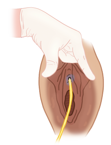 A sterile gloved hand holding the vagina open, and inserting a yellow catheter inside the urethra. There is betadine surrounding the urethra and vulva.