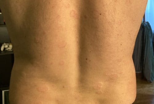 picture of plaque psoriasis on an elbow in a shirtless man
