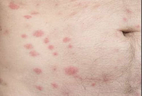 Nonspecific Skin Rash  Saint Luke's Health System