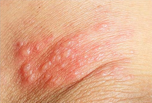 Skin Rashes Treatment Near Me in Edmond, OK