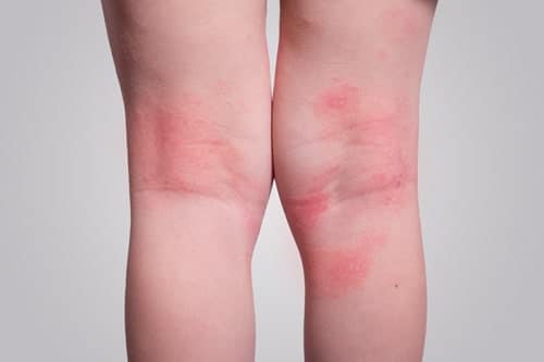 picture of contact eczema aka atopic dermatitis