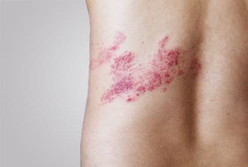 18 Acute Skin Rashes for Nurses to Know (with pictures)